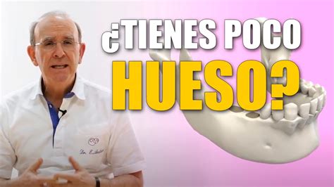 Implantes dentales sin hueso Qué soluciones hay YouTube