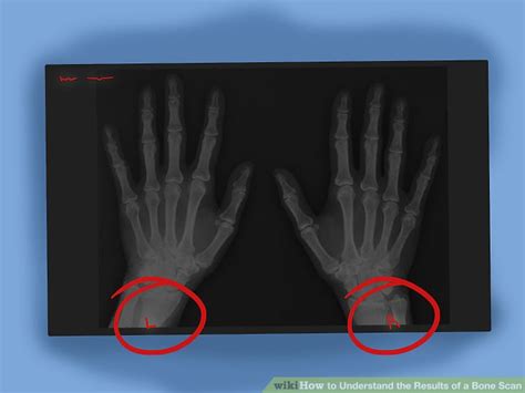 How to Understand the Results of a Bone Scan: 13 Steps