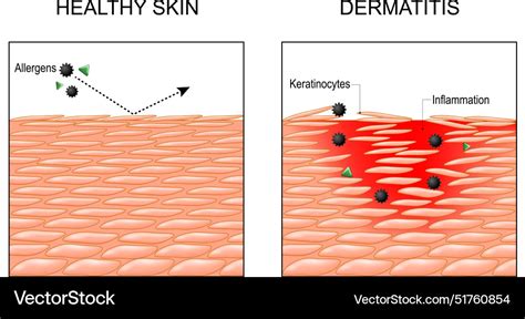 Dermatitis Eczema Psoriasis Cross Section Vector Image