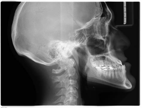 C Mo Se Ve La Caries En Una Radiograf A Cl Nica Dental Azuqueca De