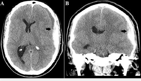 Preoperative Computed Tomography Scan Of The Patient S Head