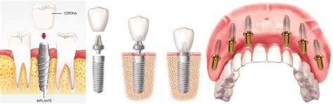 La Verdad Sobre Los Implantes Dentales Cl Nica Dental Alberto Barreiro