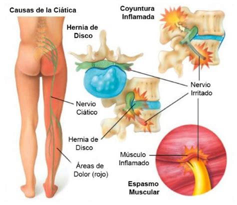 Tratamientos Seguros Y Efectivos Para El Alivio Del Dolor De Ci Tica