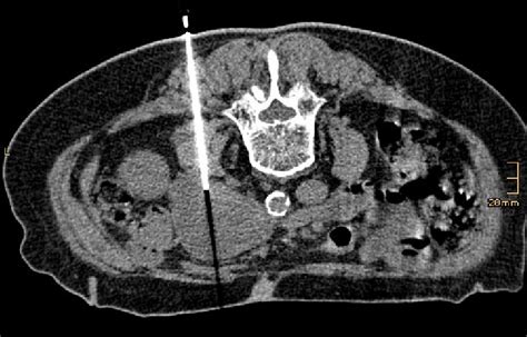 The Picture Shows The Needle End Position Of Ct Guided Core Biopsy In Download Scientific