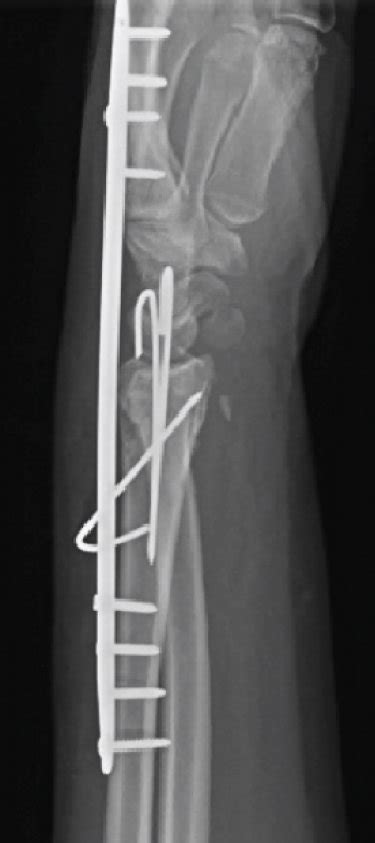 Initial Fixation Postoperative X Ray Showing Fixation With A Download Scientific Diagram