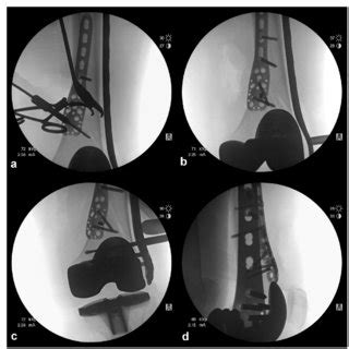 Fluoroscopic Intraoperative Images Showing A Provisional Fixation Of