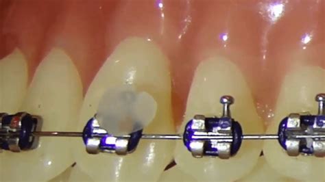 Cera para brackets Clínica Dental Mª José Barra Soto