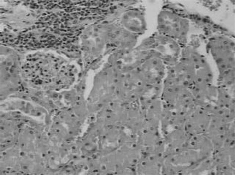 Interstitial nephritis, 8 weeks after injection of polymethyl ...