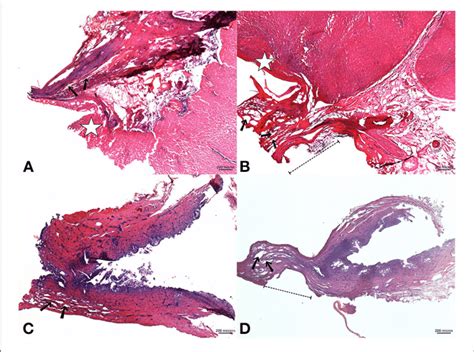 Upper Images A Microscopic View Of A Sealed Glissonean Pedicle Gp