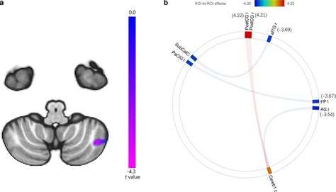 A Seed To Voxel Analysis Showing Lower Functional Connectivity Between Download Scientific