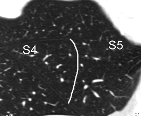 Volumetric Assessment Of Pulmonary Nodules With Ecg Gated Mdct Ajr