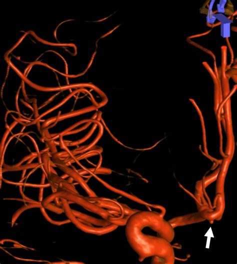 Tiny ACOM Aneurysm Coiling Expanding Range Of Endovascular Treatment