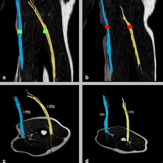 From Left To Right Coronal Maximum Intensity Projections MIP Axial