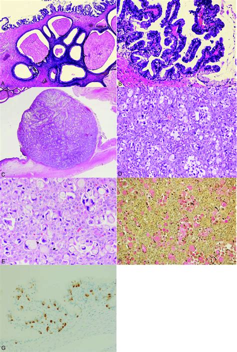 Primary Signet Ring Cell Carcinoma In Mucinous Borderline Ovarian Tumor