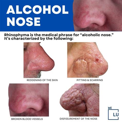 What Is Alcoholic Nose Red Appearance? Signs & How To Treat