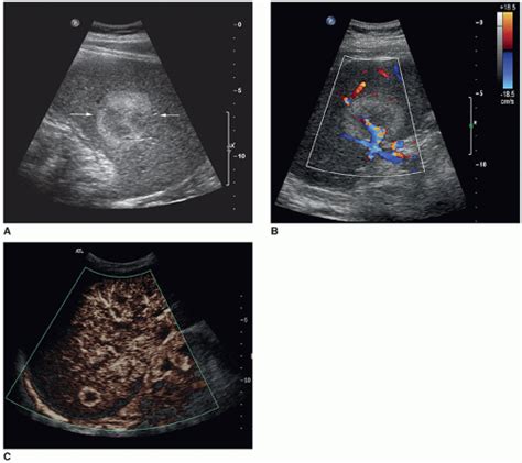 The Spleen | Radiology Key