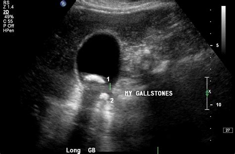 gallbladder stones ultrasound images | Gp Motor Wallpaper