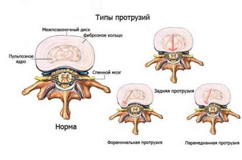 Лечение Протрузии дисков Позвоночника в Киеве - поясничного, шейного и ...