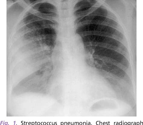 Figure 1 From Acute Lung Infections In Normal And Immunocompromised Hosts Semantic Scholar