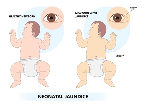 Ictericia Em Bebe - Icterícia: saiba como tratar - Eurofarma