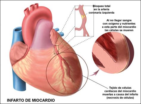 Blog Del Corazon Infarto Agudo Al Miocardio