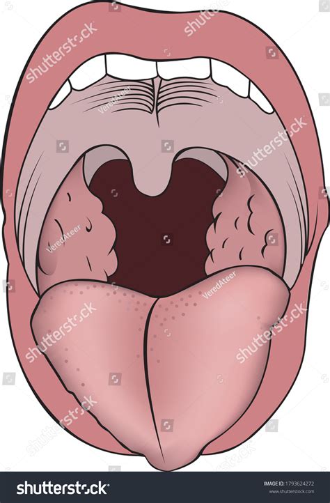 Images Adenoids Growth Lymphoid Tissue Nasopharyngeal Tonsil Stock