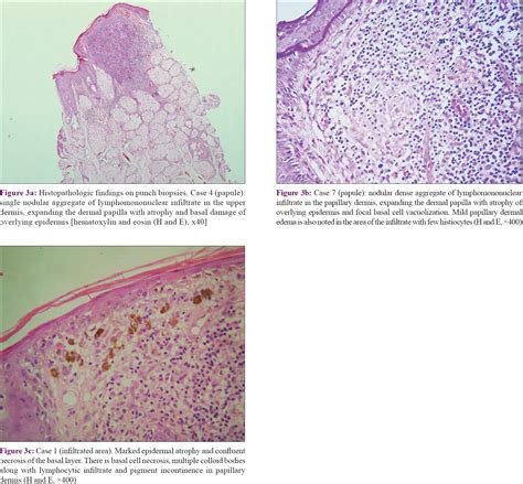 Polymorphous Light Eruption Histology