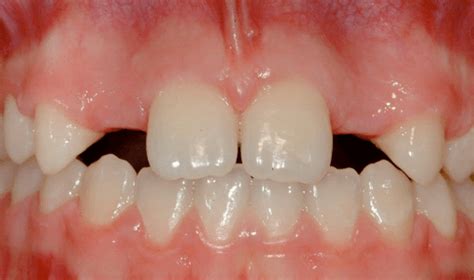 What Can We Do About Missing Lateral Incisors Kevin Obriens