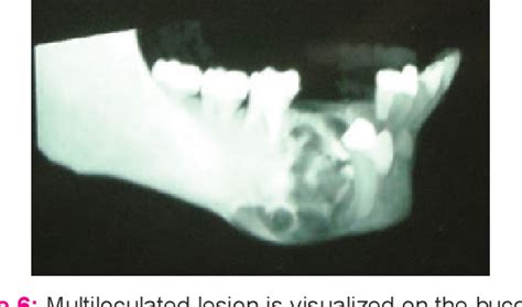 Figure From A Rare Large Odontogenic Keratocyst Of The Mandible