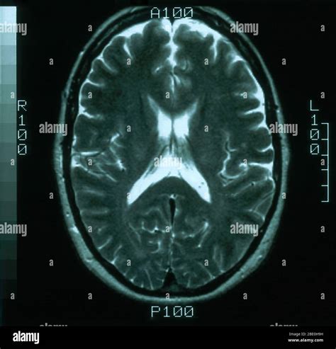 Normal brain mri hi-res stock photography and images - Alamy