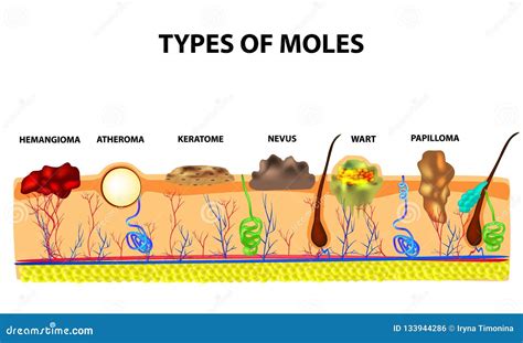 Types Of Moles Nevus Pigment Spot Papilloma Wart Keratoma