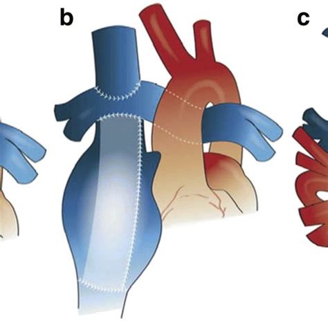 Treatment algorithm for Fontan failure | Download Scientific Diagram