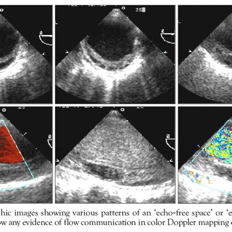 Natural history of aortic intramural hematoma with medical treatment:... | Download Table