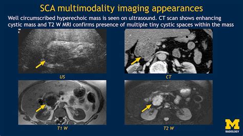 Imaging Pancreatic Cyst Youtube