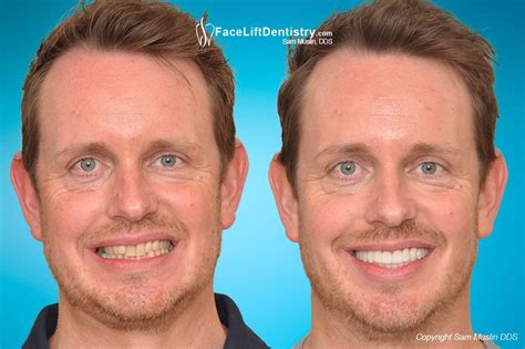 Options For Correcting An Asymmetrical Jawline Justinboey