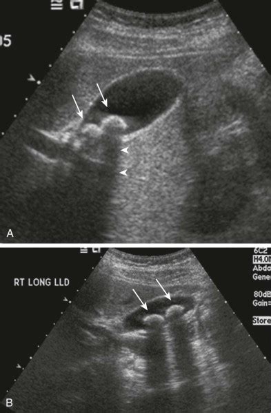 Mercedes Benz Sign In Gall Bladder Stone Cholelithiasis Refers To The