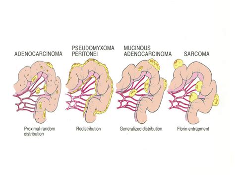 Carcinomatosis Peritoneal Instituto Quirúrgico de Andalucía IQA