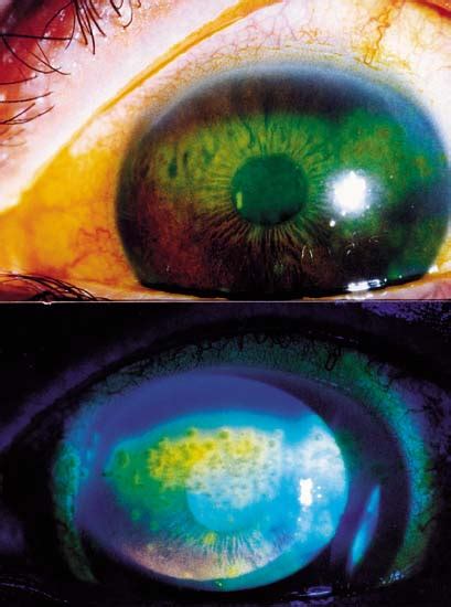 Slit Lamp Photograph Top And Fluorescein Staining Bottom Of The Od