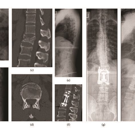 Illustrative Case A Year Old Female Patient With A T Burst