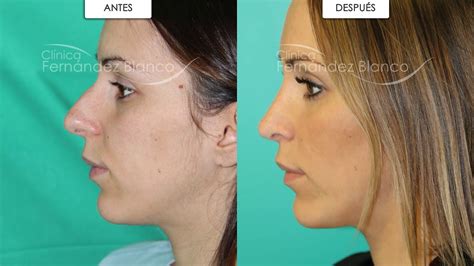 Diferencias Entre Rinoplastia Abierta Y Cerrada Youtube