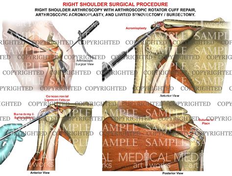 Shoulder Rotator Cuff Repair – Medical Art Works