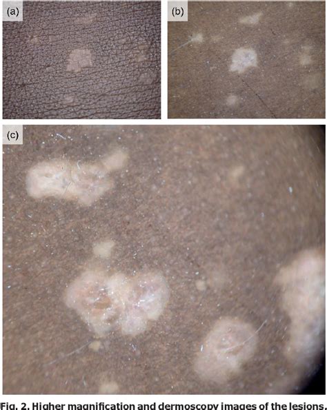 Figure From Epidermodysplasia Verruciformis In Fitzpatrick Skin Type