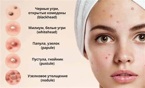 Как убрать прыщи? | История девочки Маши | Днепр (Dr.Lo)
