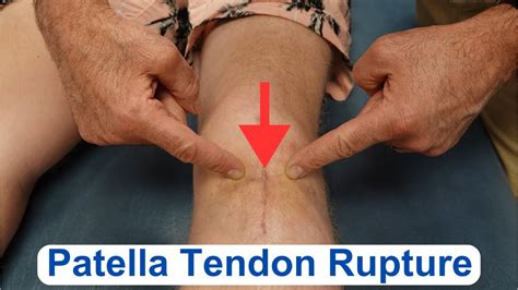 Patella Tendon Rupture Evaluation Youtube