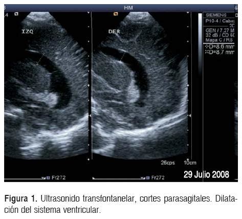 Lactante con atrofia muscular espinal y encefalopatía hipóxico isquémica