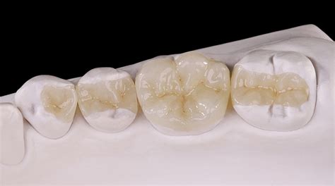 Zirconia Prettau Anterior Zirkonzahn Worldwide