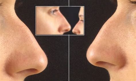 Non Surgical Nose Job V Rhinoplasty Before After Transformation