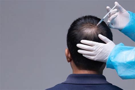 Capillary Ozone Therapy For Hair Loss And Scalp Health Elaine Medspa