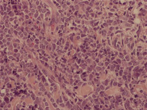 Cutaneous Granulocytic Sarcoma Arising On A Surgical Scar Indian