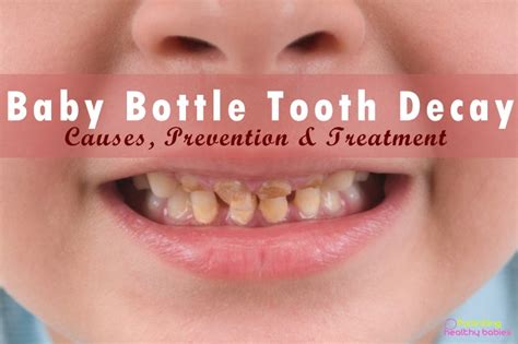 Baby Bottle Tooth Decay- Causes, Prevention and Treatment